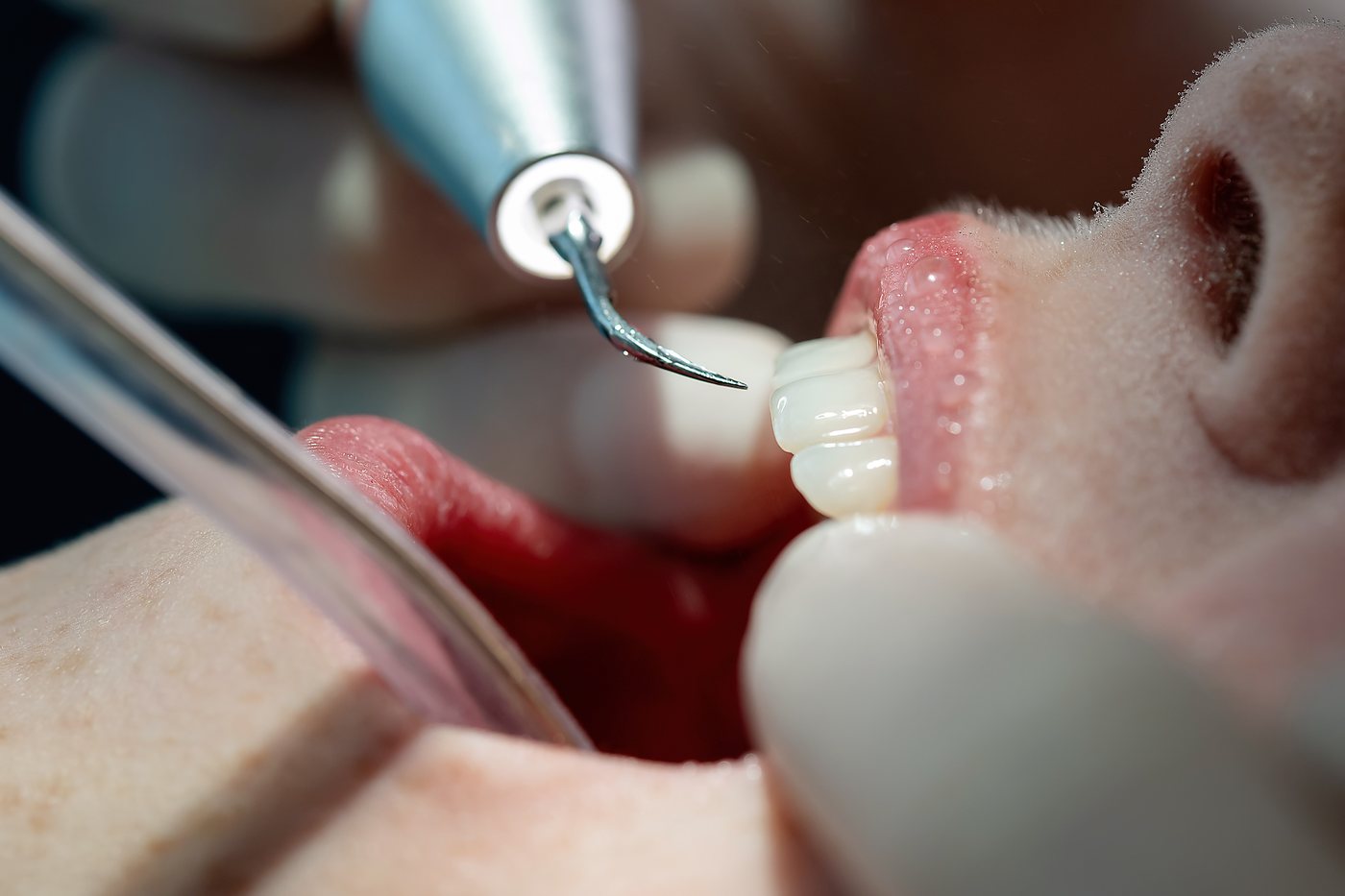 Nahaufnahme der professionellen Zahnreinigung: Ultraschall-Scaler entfernt schonend Beläge am Zahn